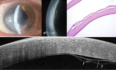 Descemet Membrane Detachment A Novel Concept In Diagnosis And