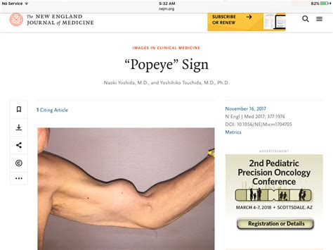 VIETNAMESE MEDIC ULTRASOUND CASE 478 POPEYE SIGN Of BICEPS MUSCLE