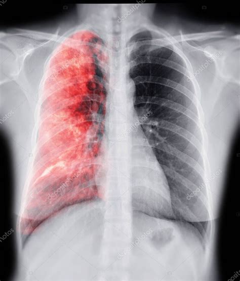 Radiografía De Tórax Con Imagen De Representación Pulmonar 3d Para