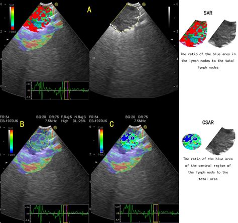 Quantitative Evaluation Of Endobronchial Ultrasound Elastography In The