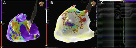 First In Human High Density Endo Epicardial Mapping And Ablation