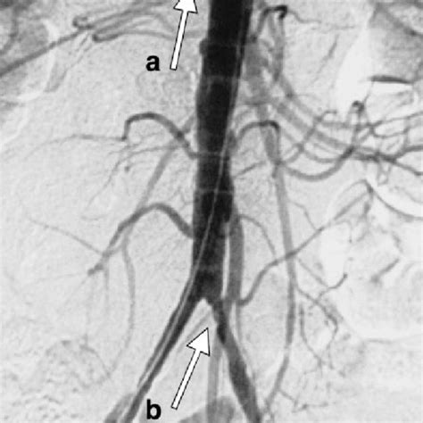 Initial Arteriogram Showing Proximal Right Renal Artery Stenosis A Download Scientific