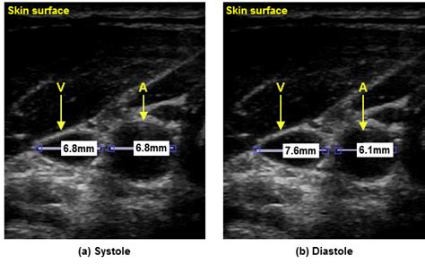 Non-contact hemodynamic imaging reveals the jugular venous pulse ...