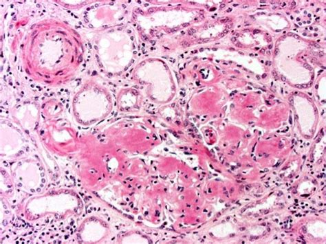 Renal amyloidosis