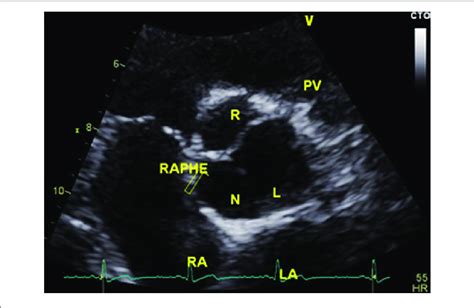 Follow Up Transthoracic Echocardiography Performed 5 Months After