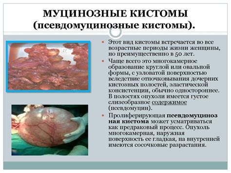 Опухоли яичников - презентация онлайн