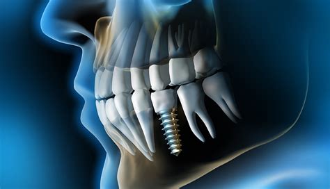 The Potential Health Risks Of Dental Implants