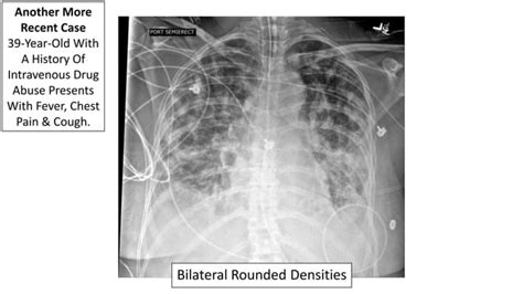 Emguidewires Radiology Reading Room Septic Pulmonary Emboli Ppt