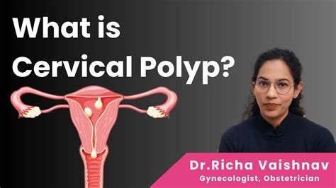 What Is Cervical Polyp Causes And Treatment Dr Richa Vaishnav