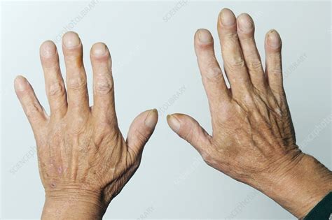 Clubbed Fingernails Stock Image C0103263 Science Photo Library