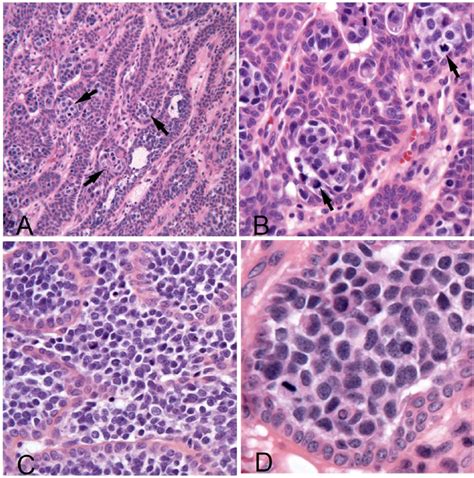 Acanthomatous Ameloblastoma With Atypical Foci In Five Dogs Jennifer