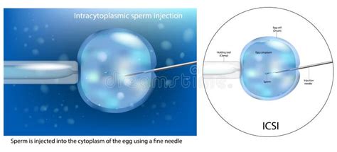 El Procedimiento De Inyección De Esperma Intracytoplasmático Icsi