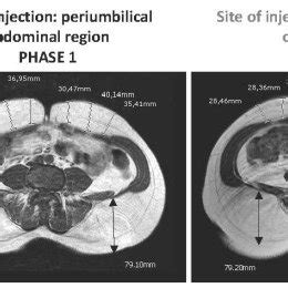 (PDF) Clinical and radiological evidence of the recurrence of ...