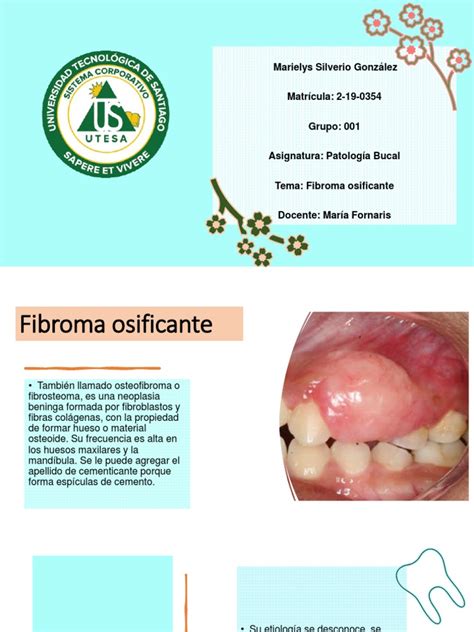 Fibroma Osificante Pdf Hueso Medicina