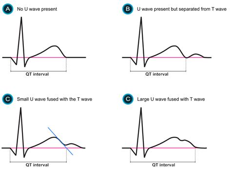 Echocardiography-Guided Risk Stratification For Long QT, 49% OFF