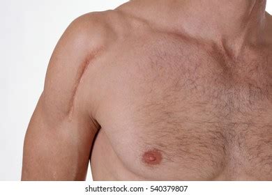 Naked Man Red Pimples On His Stock Photo 2398163673 Shutterstock