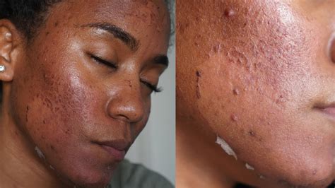 Green Peel Full Process { Procedure Peeling Before And After} No