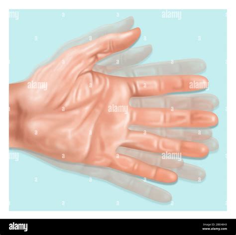 Illustration Of Hand Tremors A Symptom Of Parkinson S Disease