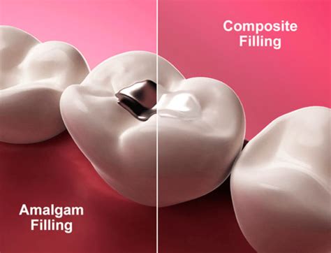 Amalgam Vs Composite Fillings Sedation Implant Dentistry