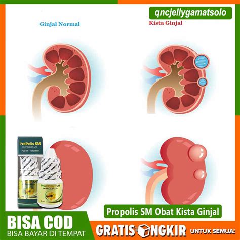 Jual Obat Kista Ginjal Benjolan Berisi Cairan Infeksi Kista Ginjal