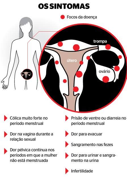 Conheça os sintomas da endometriose doença que afeta 7 milhões de