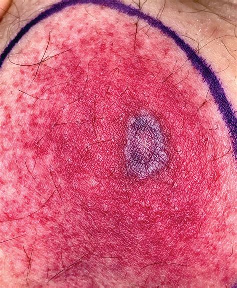 Tender Annular Plaque On The Thigh MDedge Dermatology