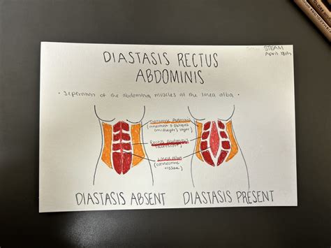 Diastasis Rectus Abdominis Mackenzie Hawkins Human Steam