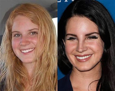 Accidentallyfuckedurdad Lana Del Rey Before And After Plastic And