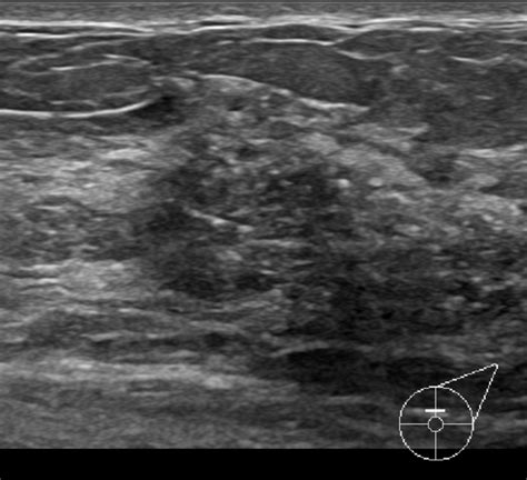 Ductal Carcinoma In Situ Dcis Image