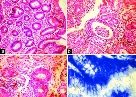 A Shows Moderate Chronic Antral Gastritis With Lymphoplasmacytic Infi Download Scientific