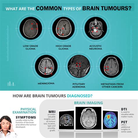 Brain tumour: Learn about what it is and about new advances in surgery ...