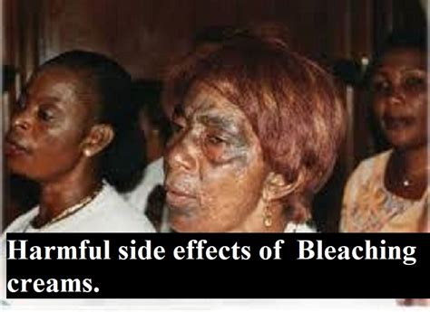 Harmful Side Effects Of Bleaching Creams. - Health - Nigeria