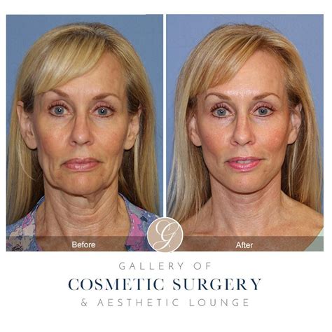 “#NaturalFacelift by @drkevinsadati” | Natural face lift, Cosmetic ...