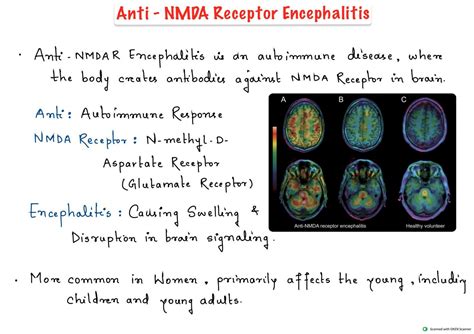 SOLUTION: Anti-NMDA Receptor Encephalitis Symptoms, Treatment Notes - Studypool