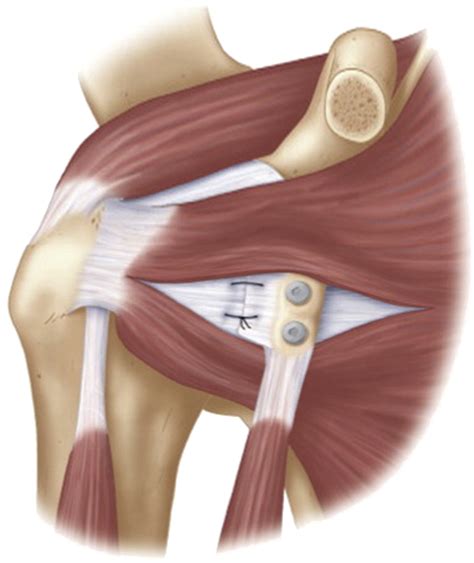 The Outcomes And Surgical Techniques Of The Latarjet Procedure