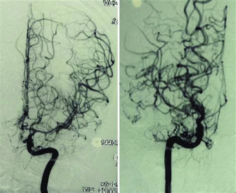 Digital Subtraction Angiography Showing Steno Occlusive Lesions Of The