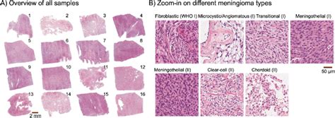 Histology Overview Panel A Shows The Sixteen Meningioma Samples That Download Scientific