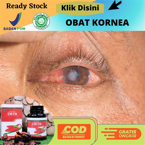 Obat Kornea Mata Mata Kornea Memutih Hilangkan Bintik Putih Di Kornea