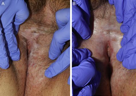 Treatment Of Vulvar Lichen Sclerosus Et Atrophicus With Fractional