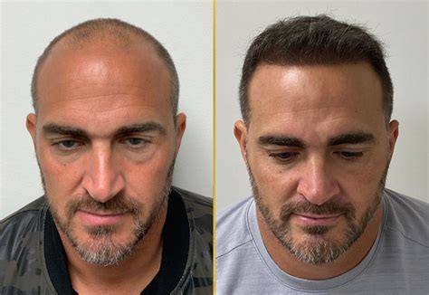 Dhi Hair Transplant In Miami Care4hair