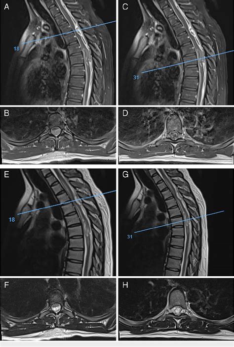 Figure 2 From Large Adult Spinal Diffuse Midline Histone H3 Lysine27 To