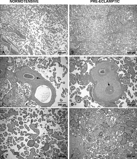 Pilot Study Of Comparative Placental Morphometry In Pre Eclamptic And