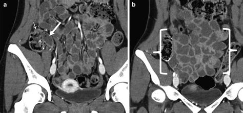 Ct Enterography Abdominal Key