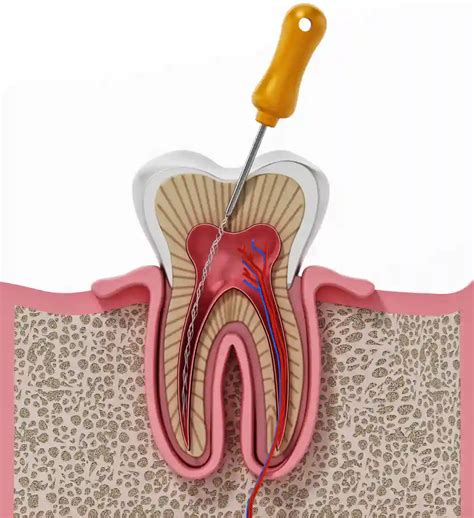 Endodonti Kanal Tedavisi Dentacenter