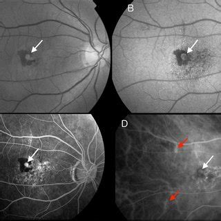 Sequential SS OCT Imaging In The Right Eye Of The Patient Of Fig 1