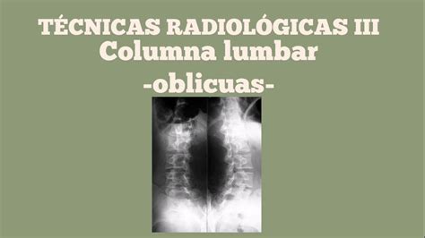 Proyecci N Oblicua De Columna Lumbar Youtube