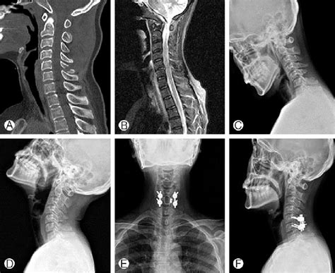 Upper Cervical Subluxation