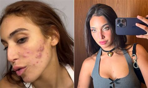 Cido Sabonete Veja Os Tratamentos Mais E Menos Eficazes Para Acne