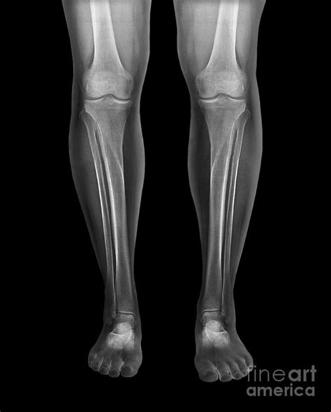 Normal Legs X Rays By Science Photo Library