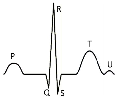 Premature Atrial Contractions Vs Premature Ventricular Contractions